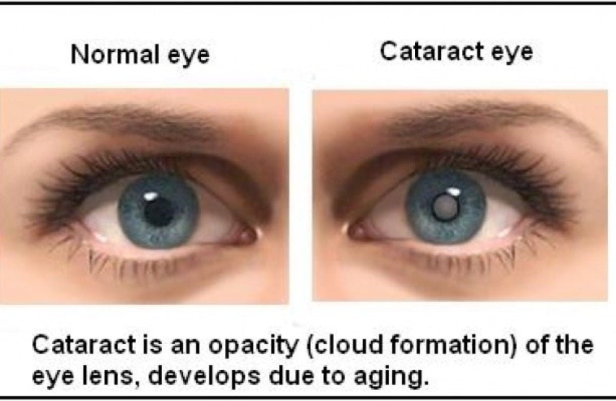 Cataract Surgery in Pakistan Cost of Laser Cataract Best Eyecare